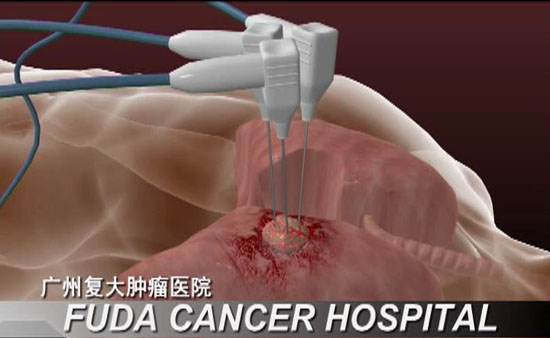 冷凍消融治療 (CSA)